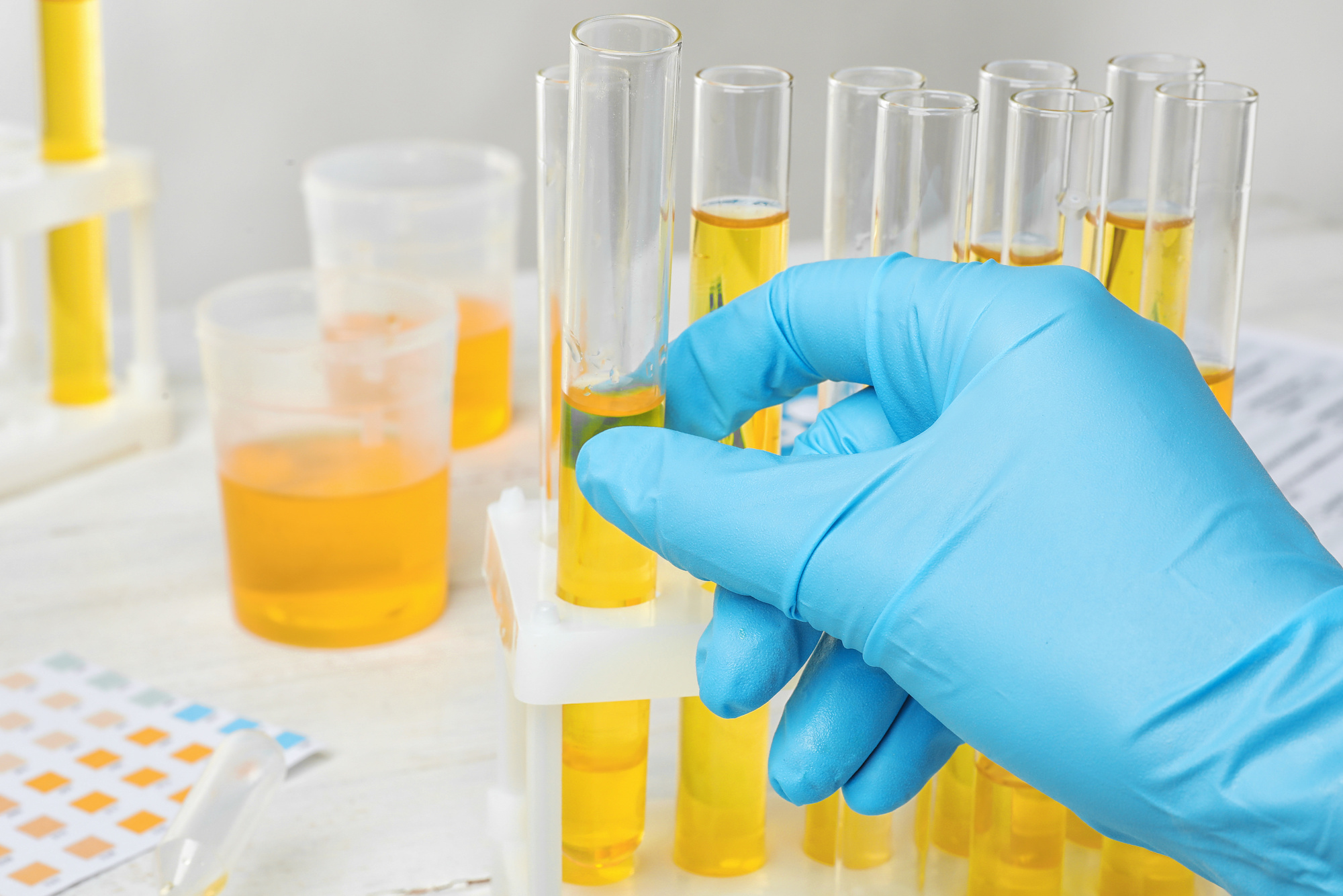 A lab tech analyzing urine color in test tubes 