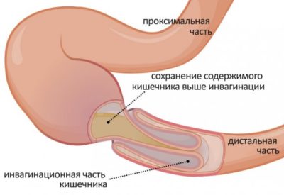 Инвагинация кишечника 