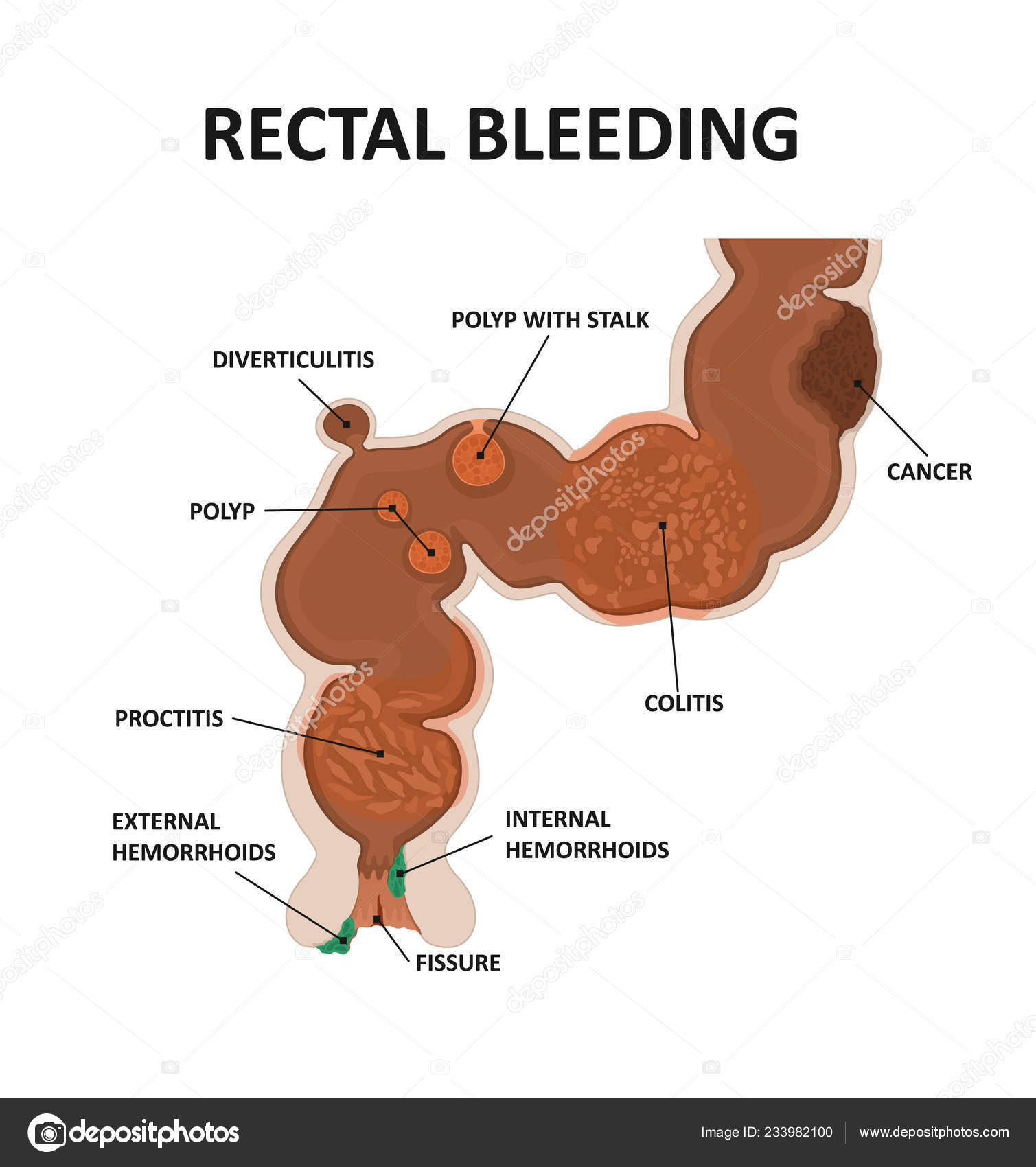 Кровь при дефекации у мужчин причины. Кровотечение из прямой кишки. Крововыделение прямой кишки. Ректальное кровотечение.